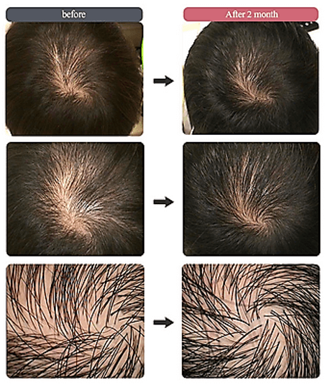 Hair Filler Treatment