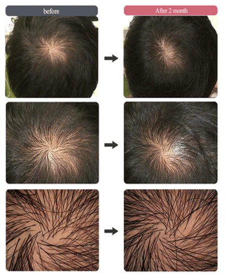 Hair Filler Treatment